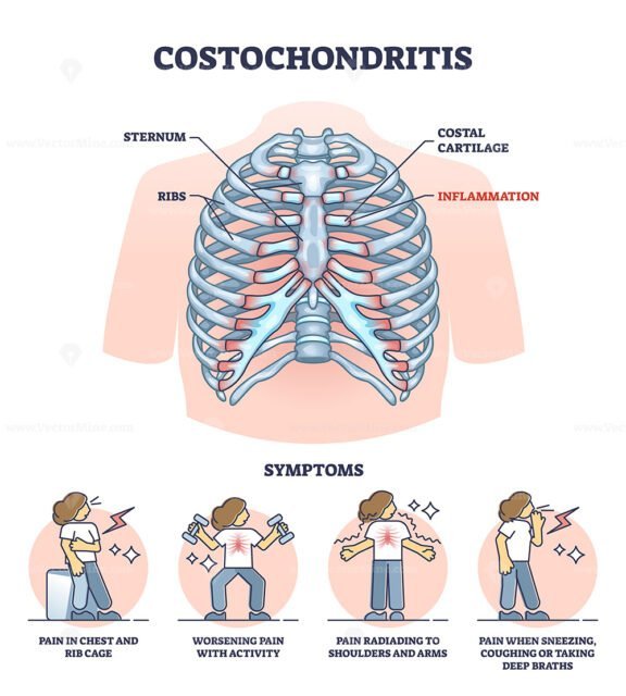 costochondritis outline 1