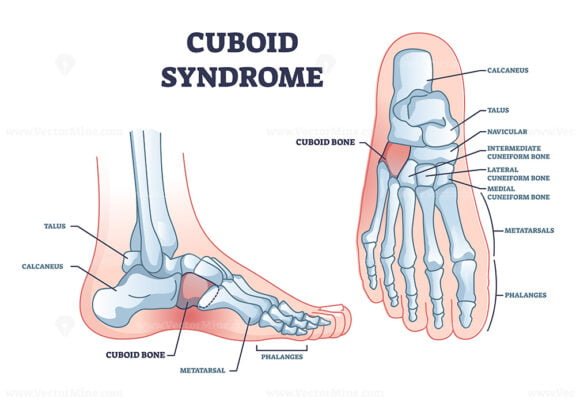 cuboid syndrome outline 1