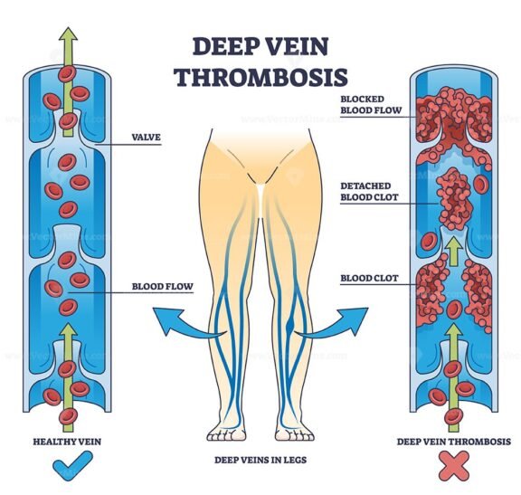deep vein thrombosis outline diagram 1