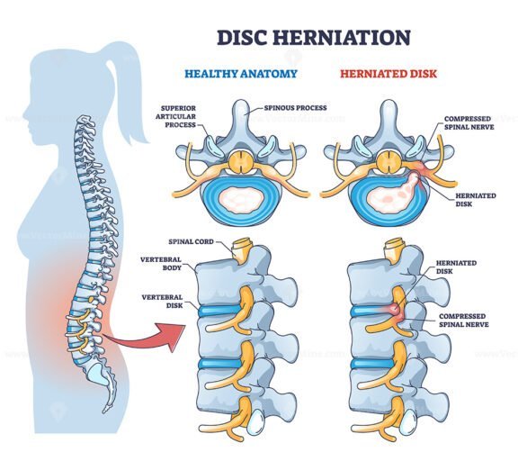 disc herniation outline 1
