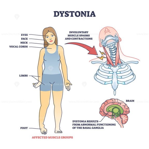 dystonia outline diagram 1