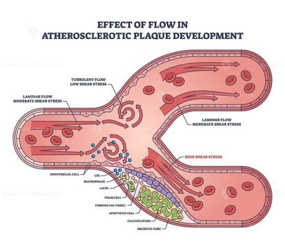 effect of flow in atherosclerotic plaque development outline 1