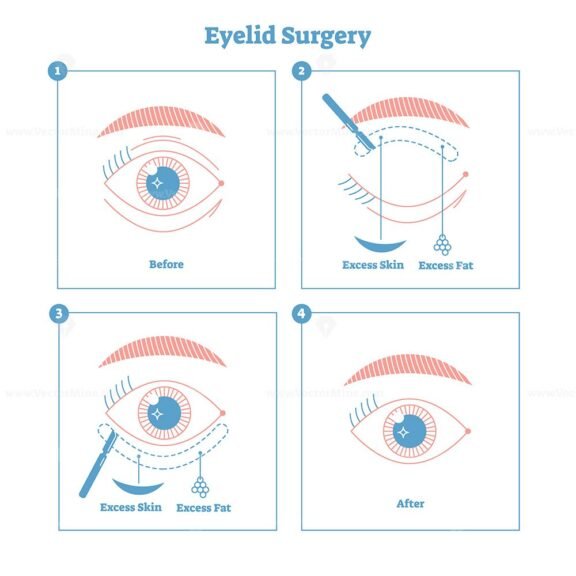 eyelid surgery 2