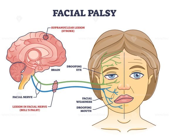 facial palsy outline 1