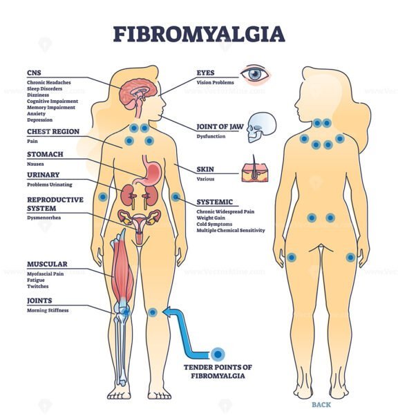 fibromyalgia outline diagram 1