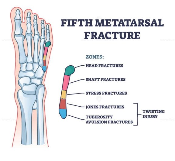 fifth metatarsal fracture outline 1