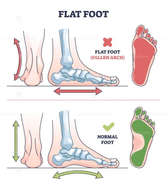 flat foot outline 1
