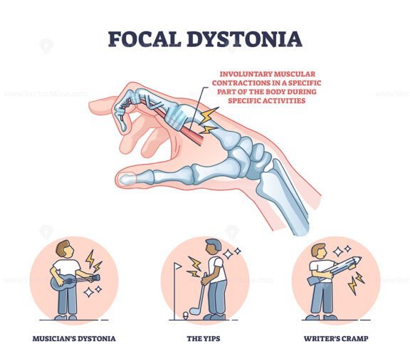 focal dystonia outline 1