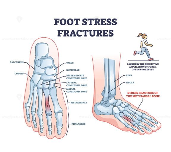 foot stress fracture outline 1