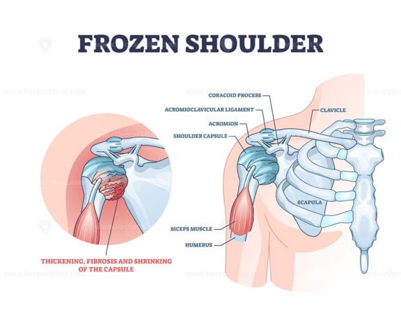 frozen shoulder outline diagram 1