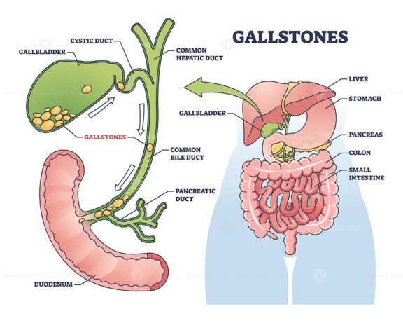 gallstones v2 outline 1