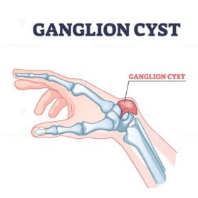 ganglion cyst outline 1