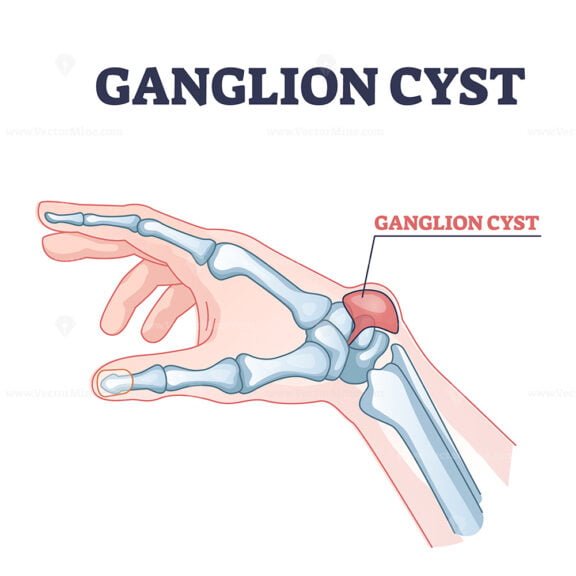 ganglion cyst outline 1