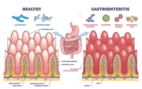 gastroenteritis v2 outline 1