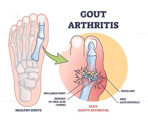 gouty arthritis outline diagram 1