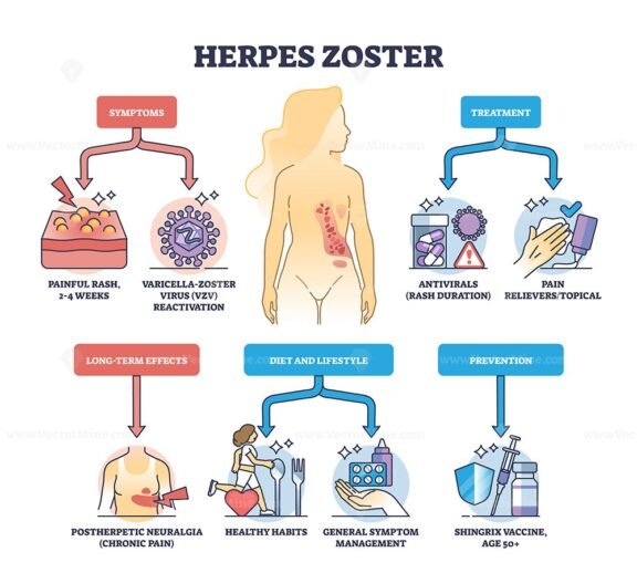 herpes zoster outline diagram 1