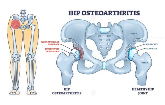hip osteoarthritis outline 1
