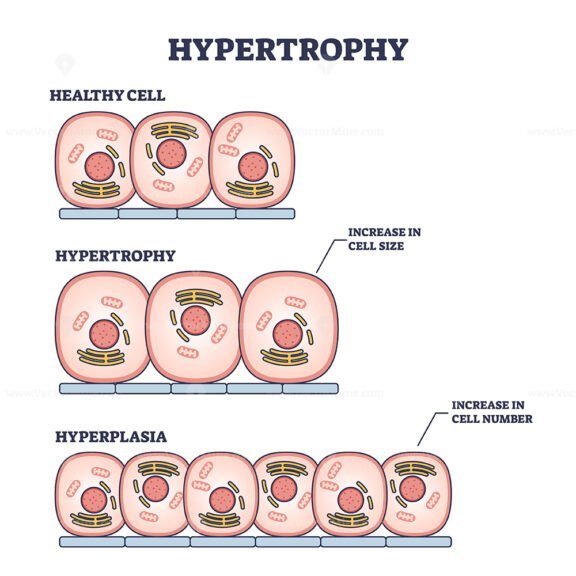 hypertrophy outline diagram 1