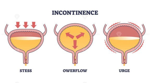 incontinence outline diagram 1