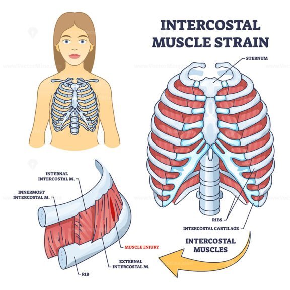 intercostal muscle strain outline 1