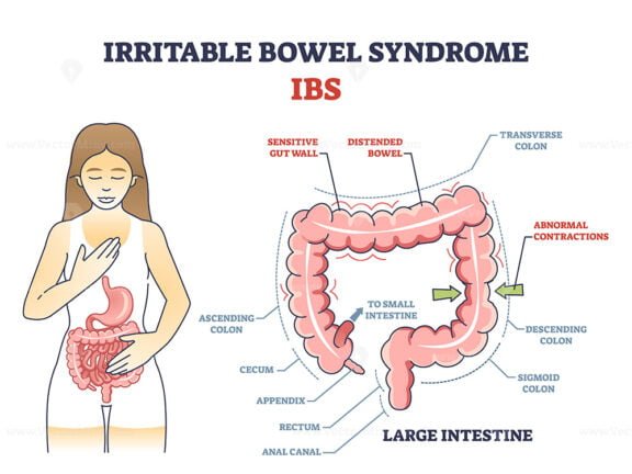 irritable bowel syndrome 2 outline 1