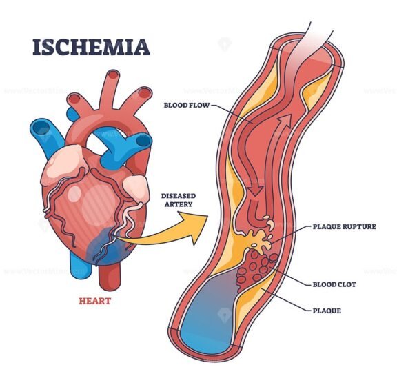 ischemia diagram 1