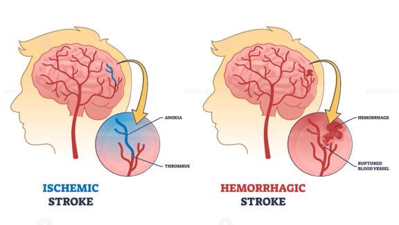 ischemic vs haemorrhagic stroke outline 1