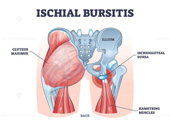ischial bursitis outline diagram 1