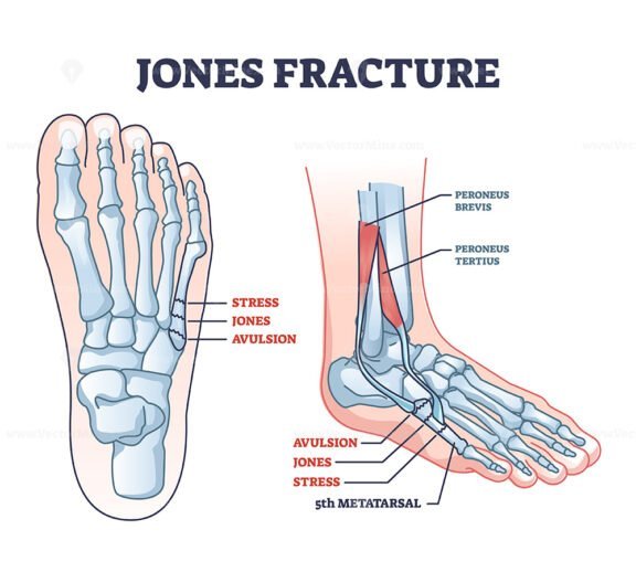jones fracture outline 1