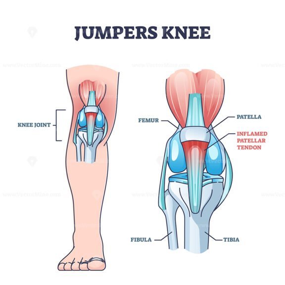 jumpers knee outline diagram 1