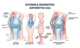 juvenile idiopathic arthritis jia outline 1