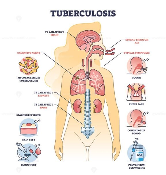 key aspects of tuberculosis tb illustrated diagram 1