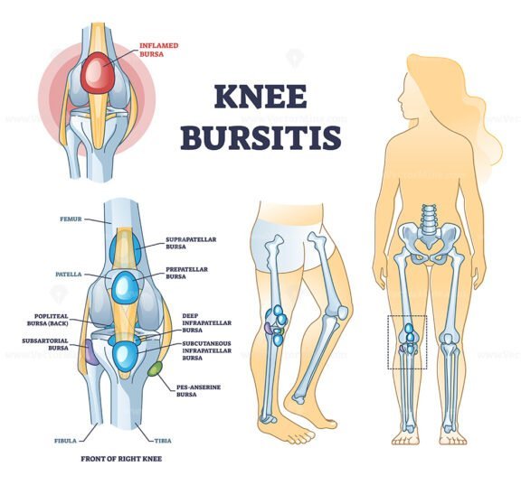 knee bursitis outline 1