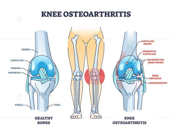 knee osteoarthritis outline 1