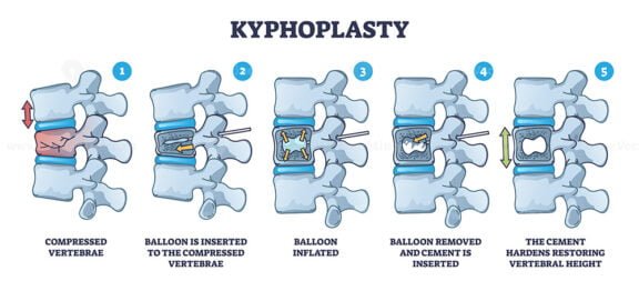 kyphoplasty outline 1