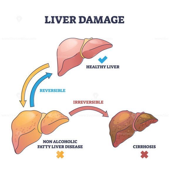 liver damage outline diagram 1