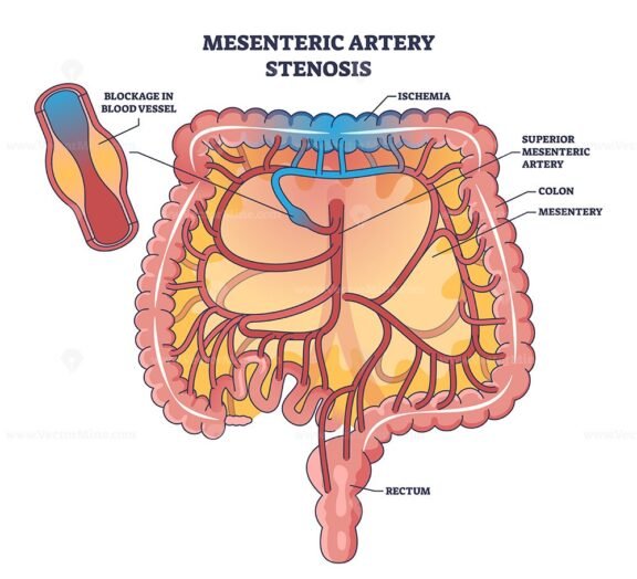mesenteric artery stenosis outline diagram 1