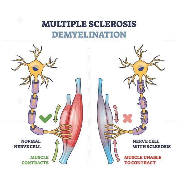multiple sclerosis demyelination outline diagram 1