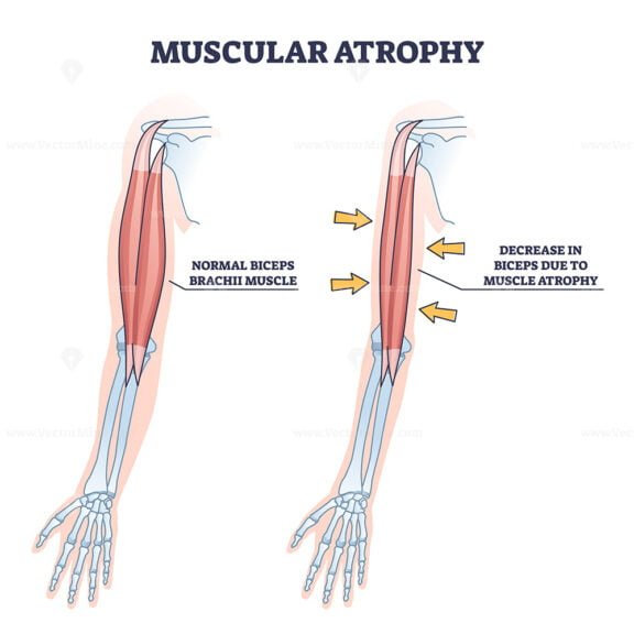 muscular atrophy outline diagram 1