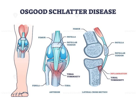 osgood schlatter disease outline 1