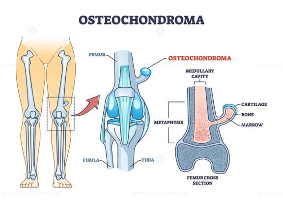 osteochondroma outline 1
