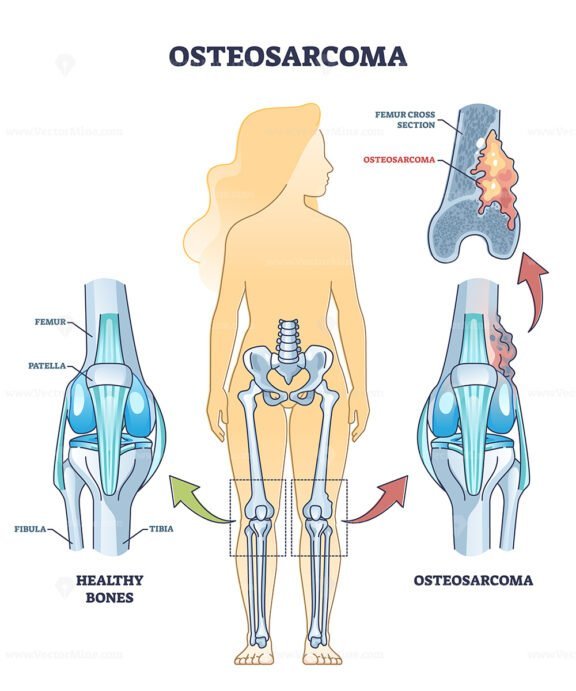 osteosarcoma outline 1