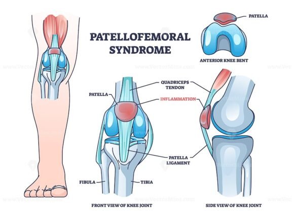 patellofemoral syndrome outline 1