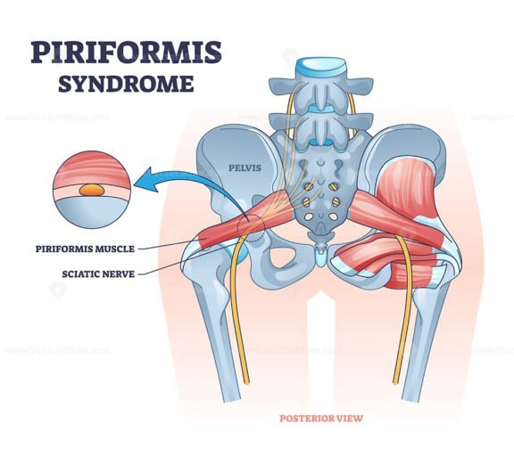 piriformis syndrome outline 1