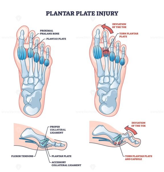 plantar plate injury outline 1
