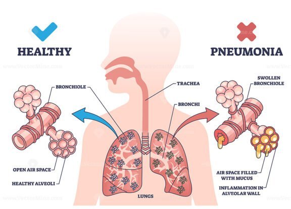 pneumonia v2 outline 1