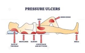 pressure ulcers outline diagram 1