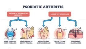 psoriatic arthritis outline diagram 1
