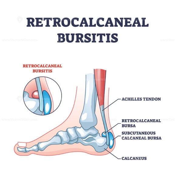 retrocalcaneal bursitis outline 1