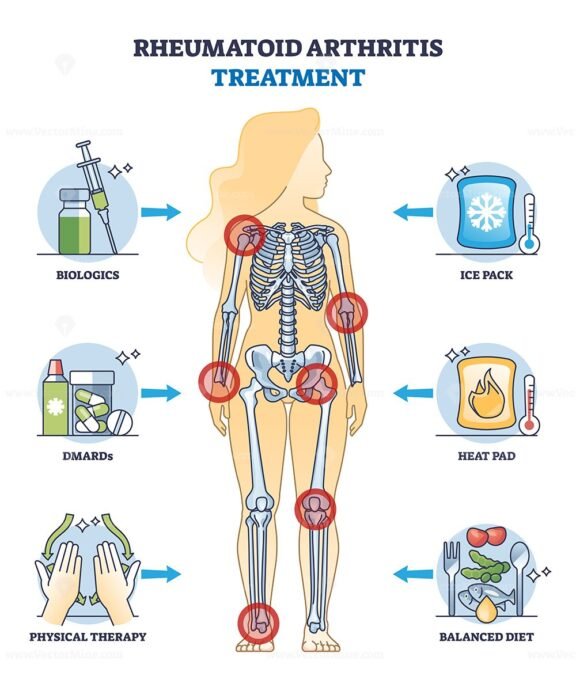 rheumatoid arthritis treatment v2 outline diagram 1